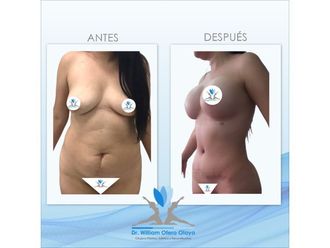 Lipoescultura - 701293