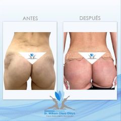 Gluteoplastia - Dr. William Otero Olaya