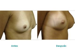 Mamoplastia