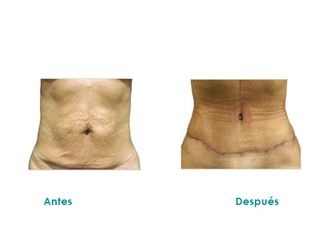 Abdominoplastia