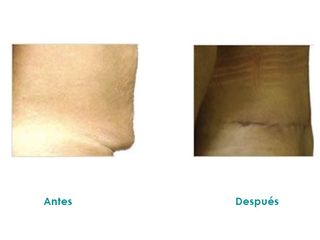 Abdominoplastia