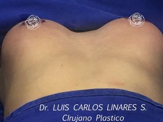  Mamoplastia de Aumento