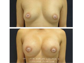  Mamoplastia de Aumento
