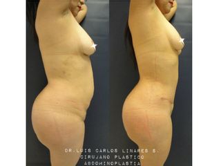 Abdominoplastia