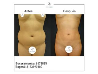 Liposucción