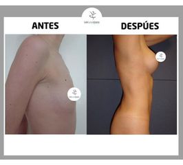 Mamoplastia de aumento