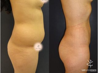 Lipoescultura