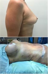 Mamoplastia de aumento - Dr. Yidio Jalaff Cirujano Plástico