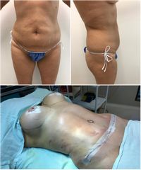 Abdominoplastia - Dr. Yidio Jalaff Cirujano Plástico