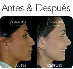 Rinoplastia o cirugía de nariz en Bogotá Colombia