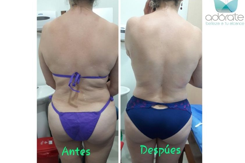 Carboxiterapia antes y después - 593378