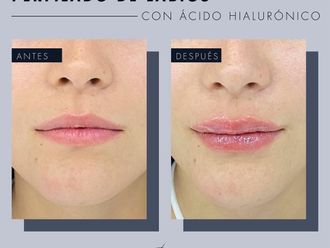 Aumento de labios antes y después - 869250