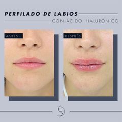 Aumento de labios - Luvent