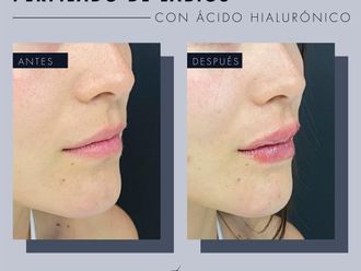 Aumento de labios antes y después - 869251