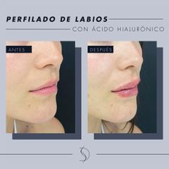 Aumento de labios - Luvent