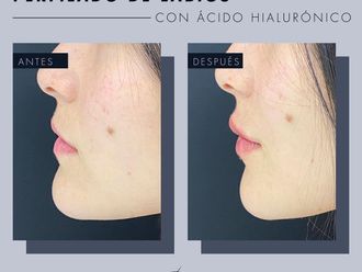 Aumento de labios antes y después - 869252