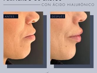 Aumento de labios antes y después - 869255