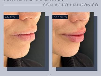 Aumento de labios antes y después - 869256