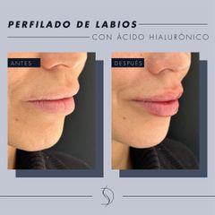 Aumento de labios - Luvent