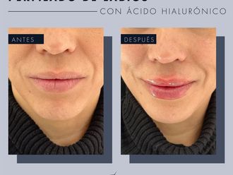 Aumento de labios antes y después - 869257