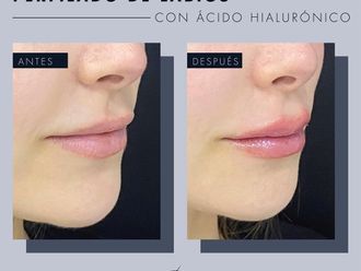 Aumento de labios antes y después - 869258