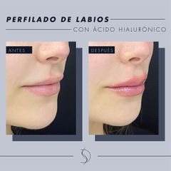 Aumento de labios - Luvent