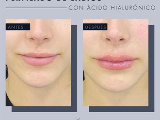 Aumento de labios antes y después - 869259