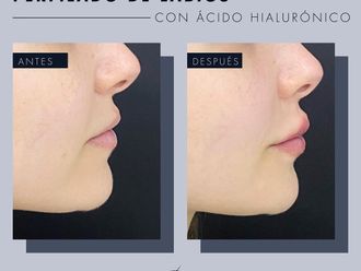 Aumento de labios antes y después - 869260