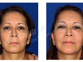 Blefaroplastia