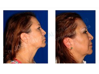 Blefaroplastia