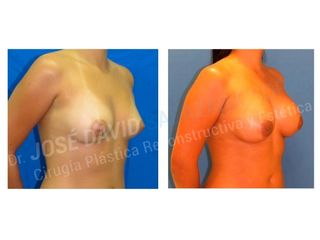Mamoplastia de Aumento