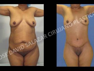 Lipoabdominoplastia