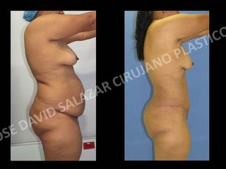 Lipoabdominoplastia
