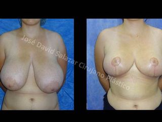 Mamoplastia de Reducción