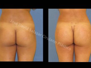 implantes gluteos