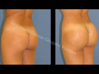implantes gluteos