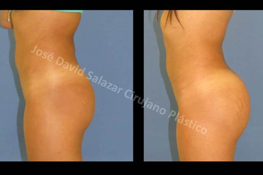 Gluteoplastia antes y después - 591336