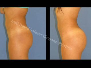 implantes gluteos