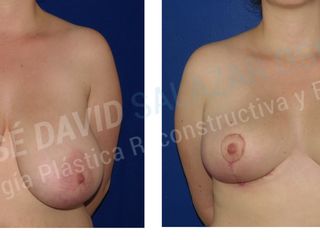 Antes y despues de mamoplastia de reduccion