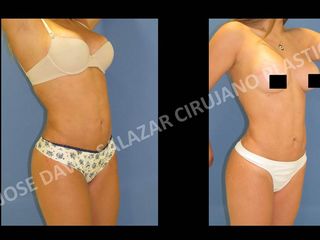 Antes y despues de lipoescultura