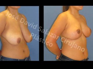 Mamoplastia de Reducción