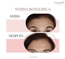 Toxina Botulínica - Dra. Fanny Rosero Narváez
