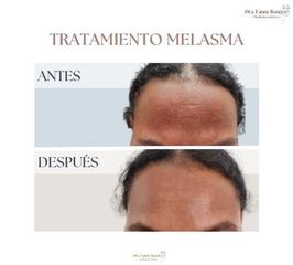 SkinCare Melasma - Dra. Fanny Rosero Narváez