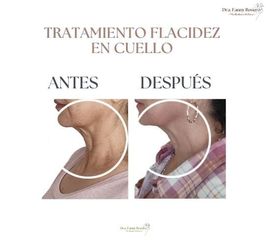 Tratamiento flacidez en cuello - Dra. Fanny Rosero Narváez