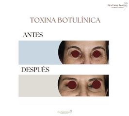 Toxina Botulínica  - Dra. Fanny Rosero Narváez