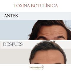 Toxina Botulínica  - Dra. Fanny Rosero Narváez