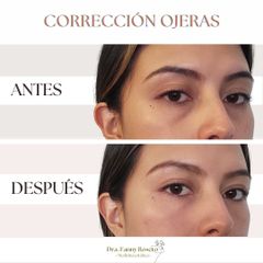 Eliminar ojeras - Dra. Fanny Rosero Narváez
