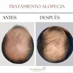 Alopecia - Dra. Fanny Rosero Narváez