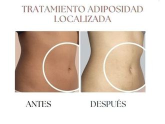 Mesoterapia antes y después - 845585