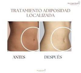 Mesoterapia - Dra Fanny Rosero Narváez